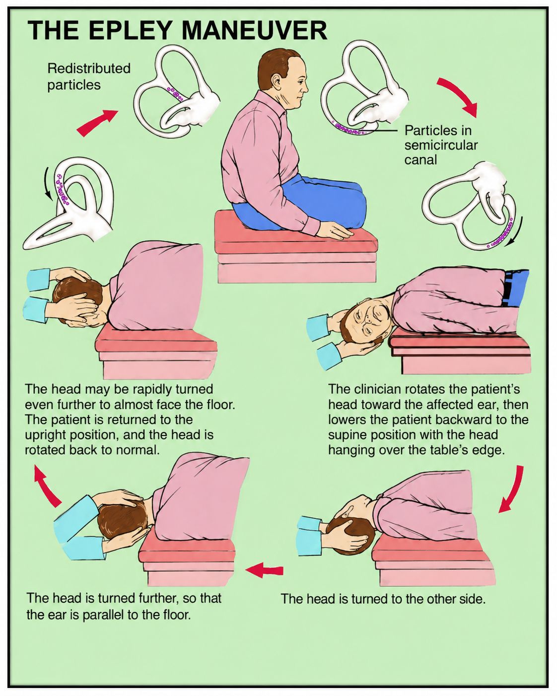 The Epley maneuver for vertigo